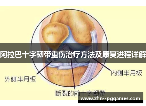阿拉巴十字韧带重伤治疗方法及康复进程详解
